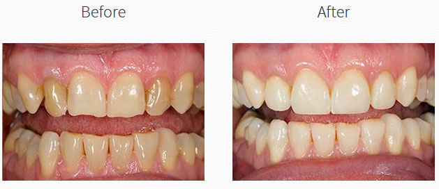 The image shows a side-by-side comparison of a person s teeth before and after dental treatment, highlighting the transformation achieved through cosmetic dentistry.