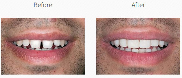The image shows a before-and-after comparison of a person s teeth, with the  before  side showing yellowed or discolored teeth and the  after  side displaying clean, white teeth.